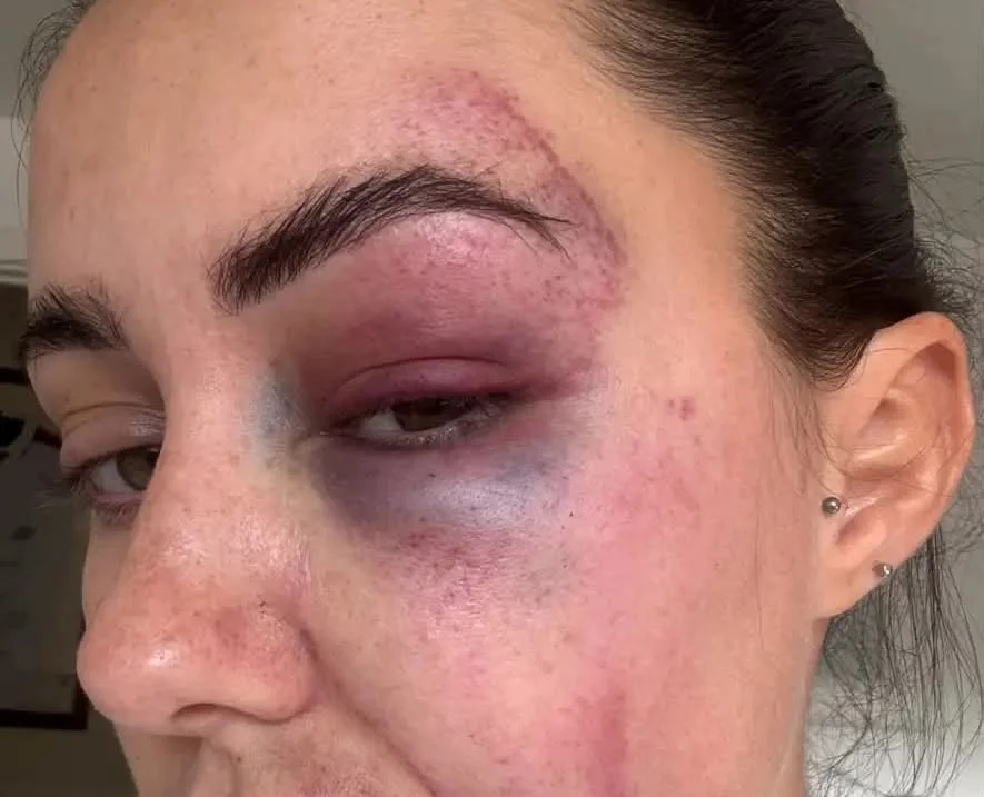 Woman's face showing bruising around eye and cheek with slight swelling to lips