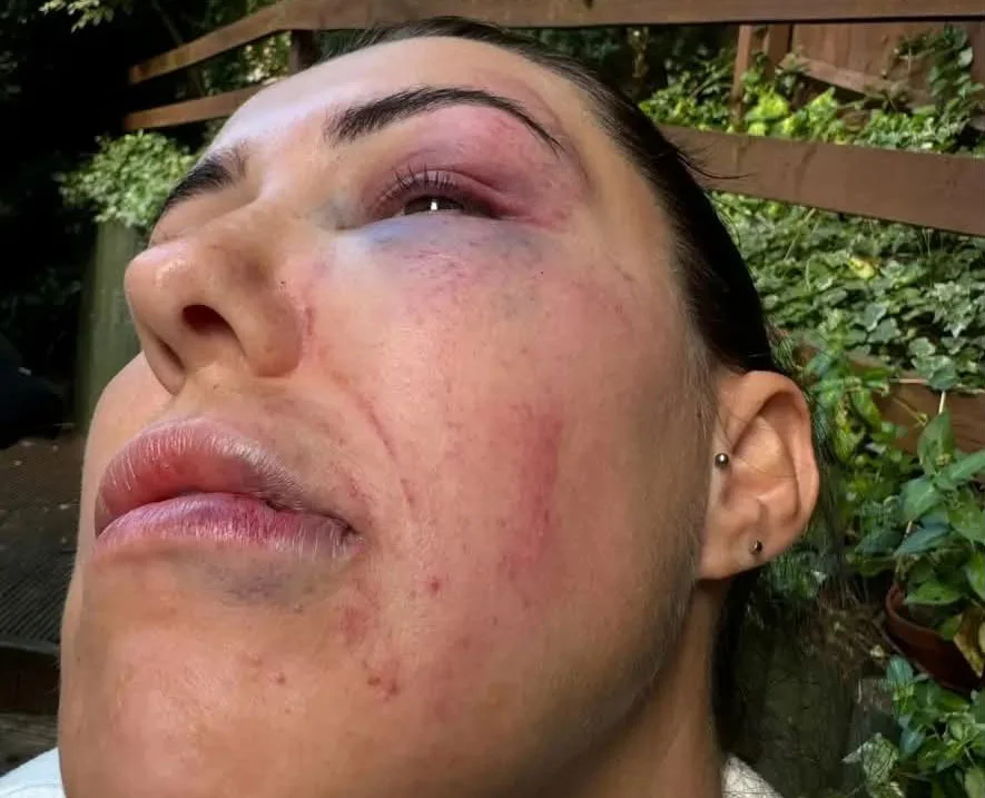 Woman's face showing extensive bruising around both eyes and swelling throughout face