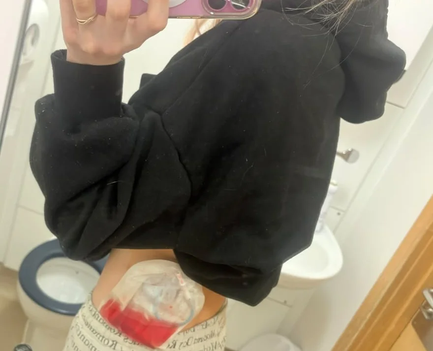 Close-up of woman's hand holding phone showing nephrostomy bag with coloured fluid.