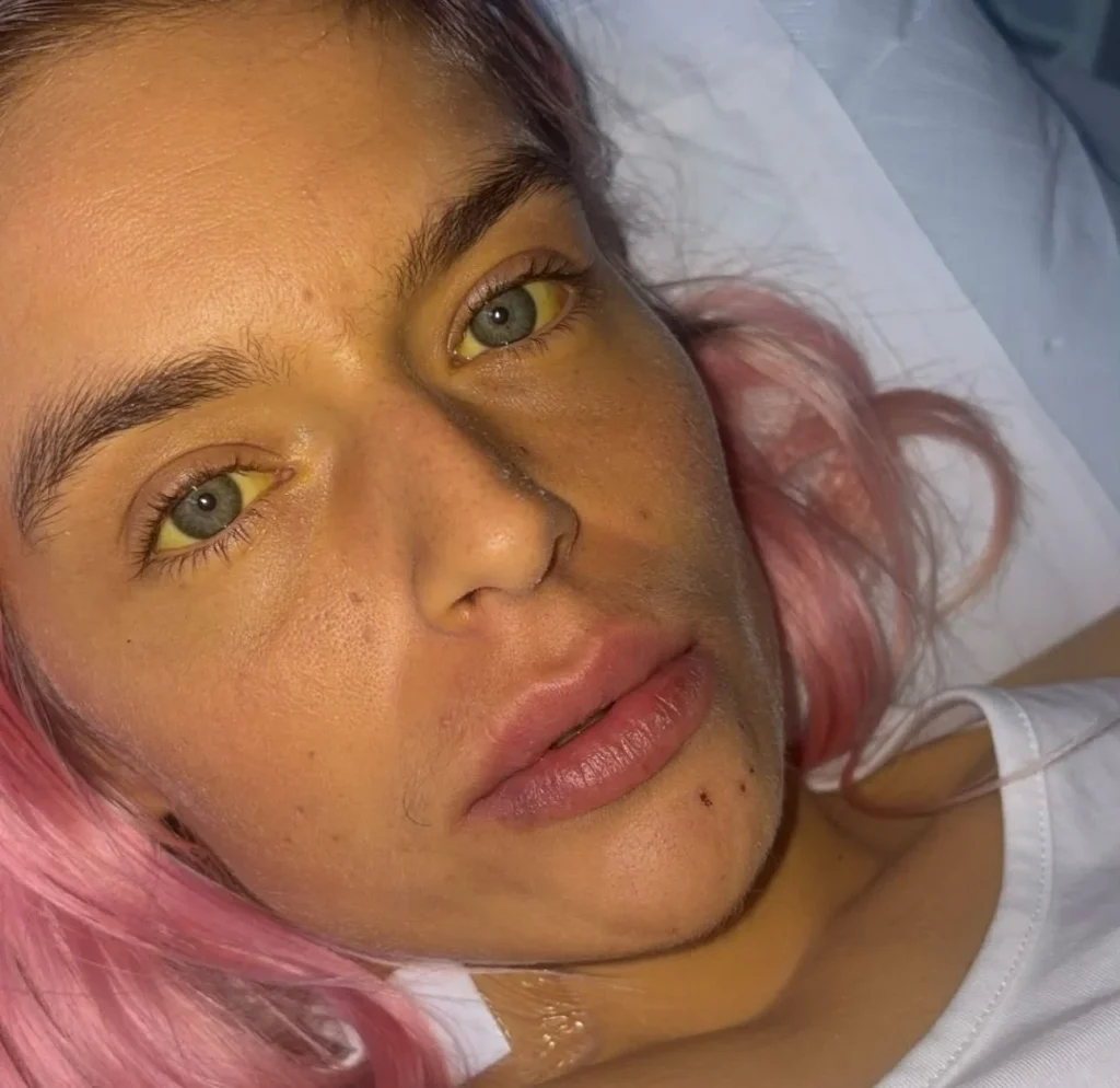 Woman with jaundiced yellow skin and eyes in hospital gown on white pillows.