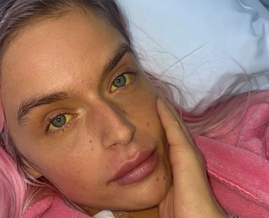 Woman with jaundiced yellow skin lying in hospital bed with pink hair.