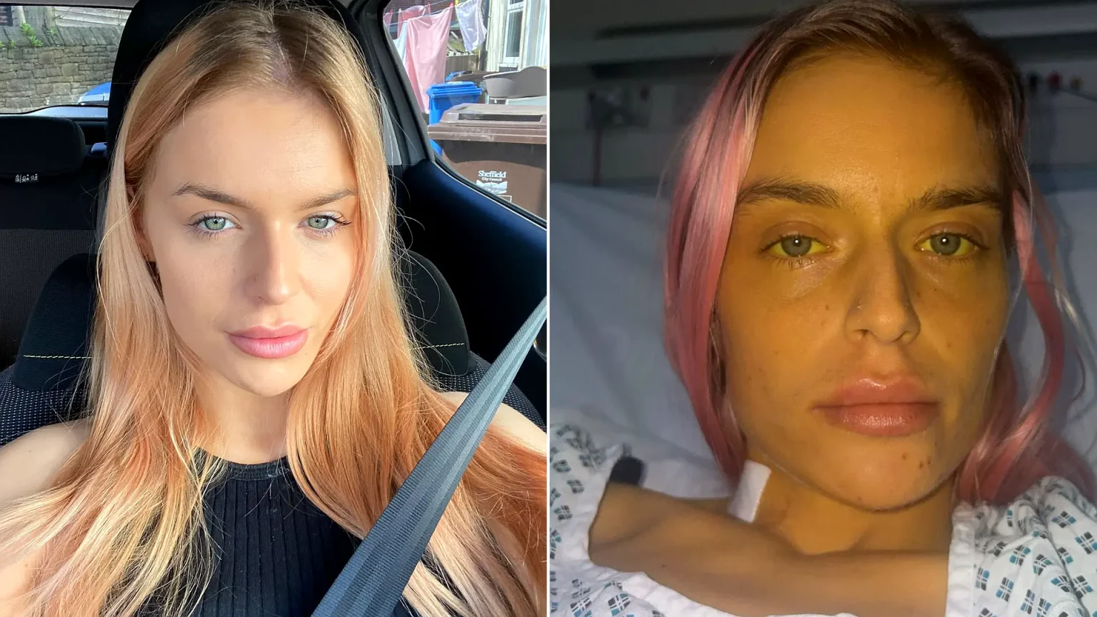 Left: Georgia Lee Hampshire with healthy complexion and reddish hair. Right: Same woman with severe jaundicing, yellow skin and eyes, in hospital bed.