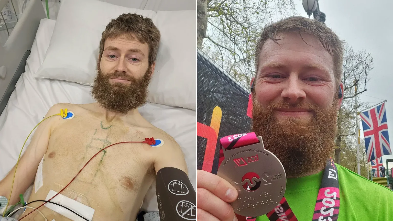 Runner Chris Poole's life was saved by his run club when he suffered cardiac arrest mid-jog. CPR and a defibrillator proved life-saving during his shocking collapse.