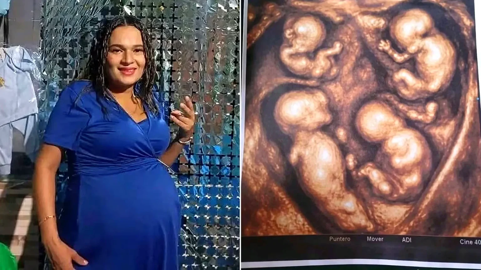 Mum-to-be, 38, pregnant with four identical boys in a 'one-in-15 million' miracle. The monozygotic quadruplets share the same placenta in this exceptional Colombian pregnancy.