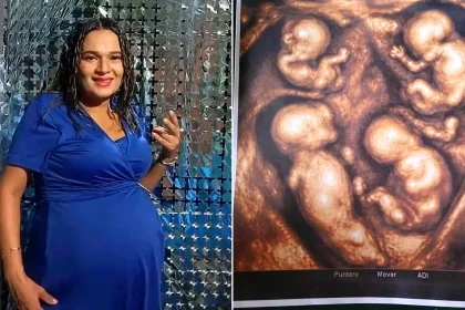 Mum-to-be, 38, pregnant with four identical boys in a 'one-in-15 million' miracle. The monozygotic quadruplets share the same placenta in this exceptional Colombian pregnancy.