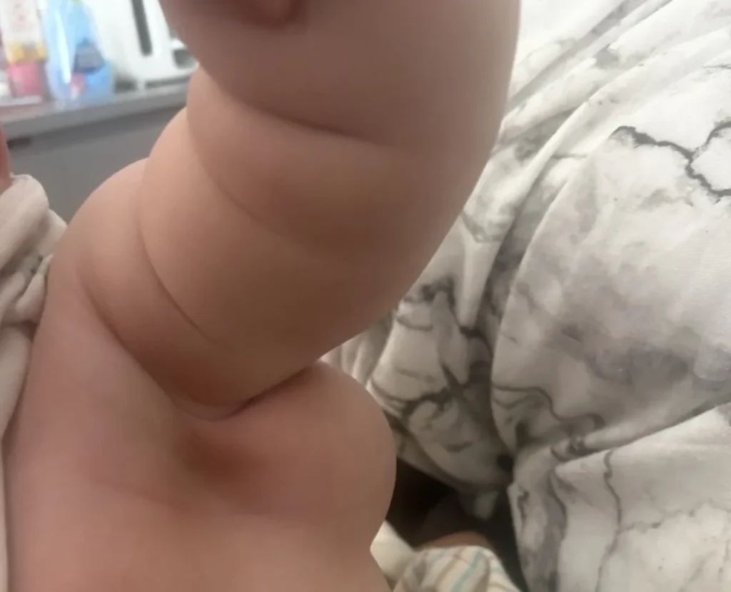 A mother has told of her worry as a huge tumour on her son's side grew so rapidly that it’s forcing his arm into the air.