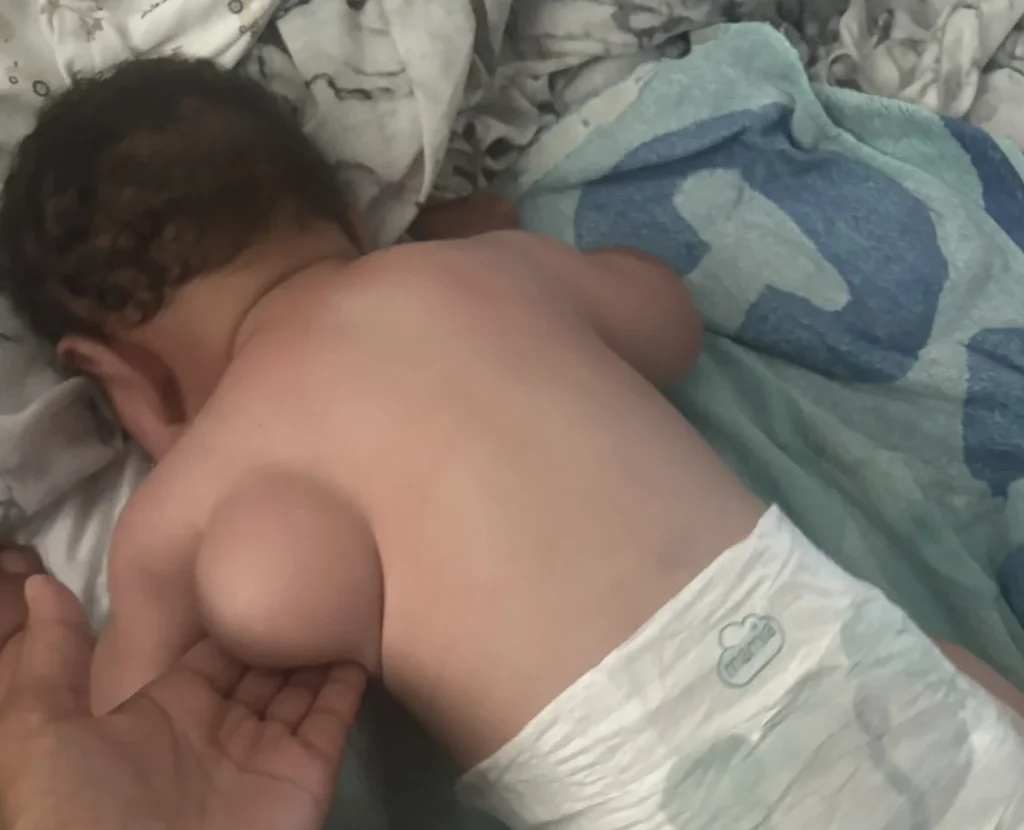 A mother has told of her worry as a huge tumour on her son's side grew so rapidly that it’s forcing his arm into the air.