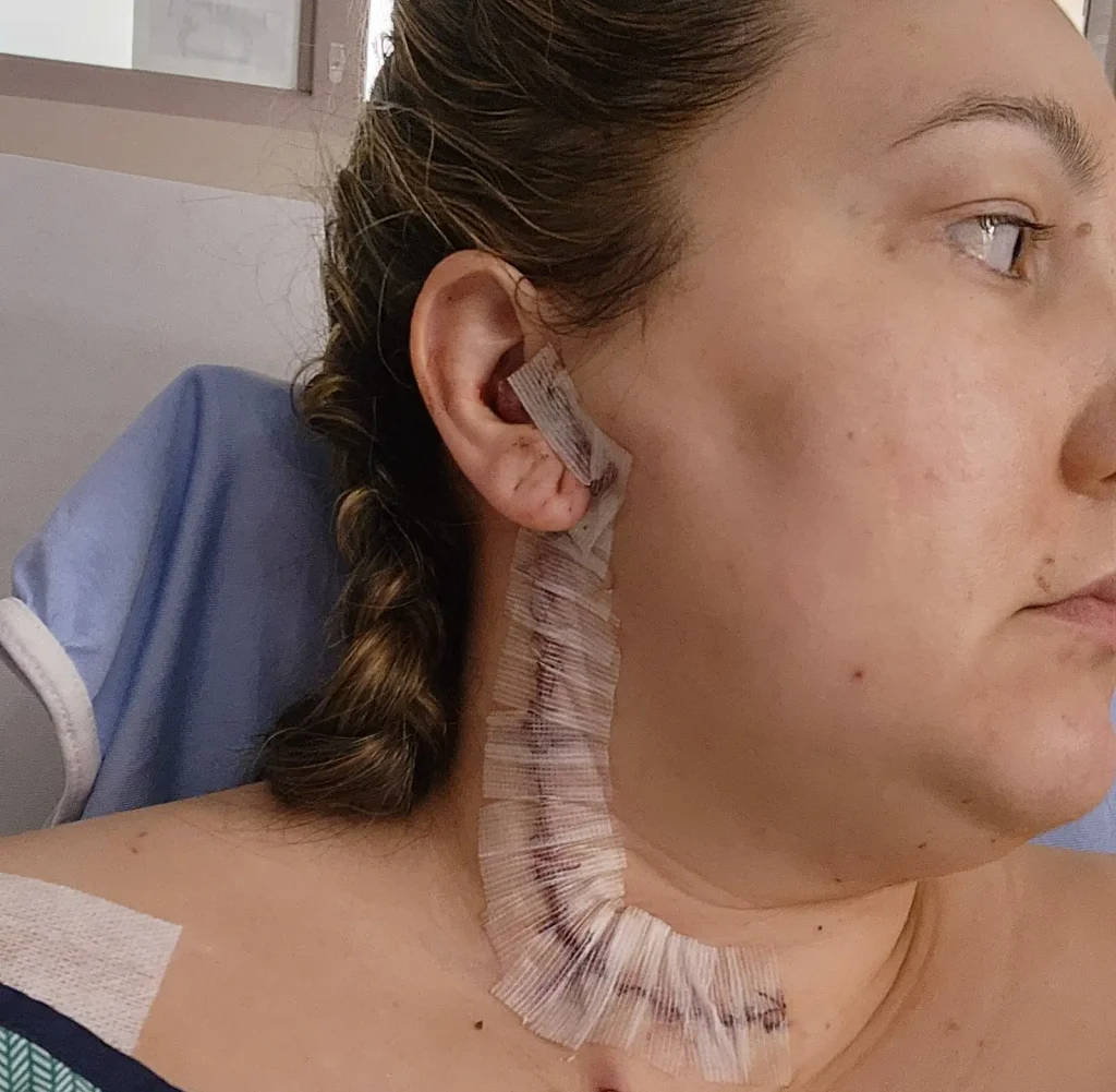 Woman displaying surgical stitches running down the side of her neck.