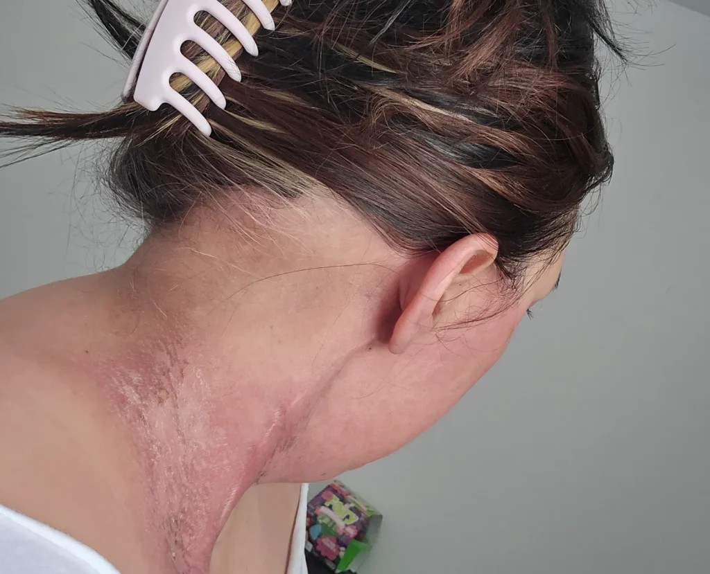 Back of woman's head and neck showing surgical scarring from treatment.