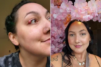 Left: Woman showing a small red lump on her eyelid. Right: Same woman now healthy and smiling indoors wearing a cream jumper.