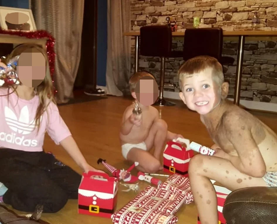 Mum feared for son's future after rare hairy birthmark covered half his face at birth, but he's now the most popular kid in school.
