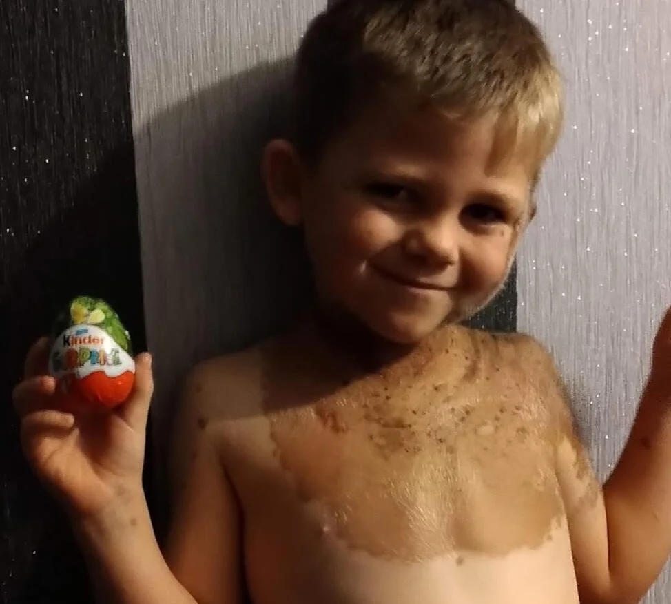 Mum feared for son's future after rare hairy birthmark covered half his face at birth, but he's now the most popular kid in school.