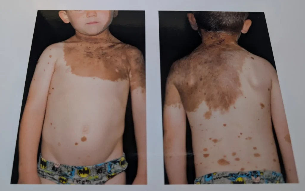 Hospital photograph showing a young boy from profile and front angles displaying congenital melanocytic naevi birthmarks on his head and neck.