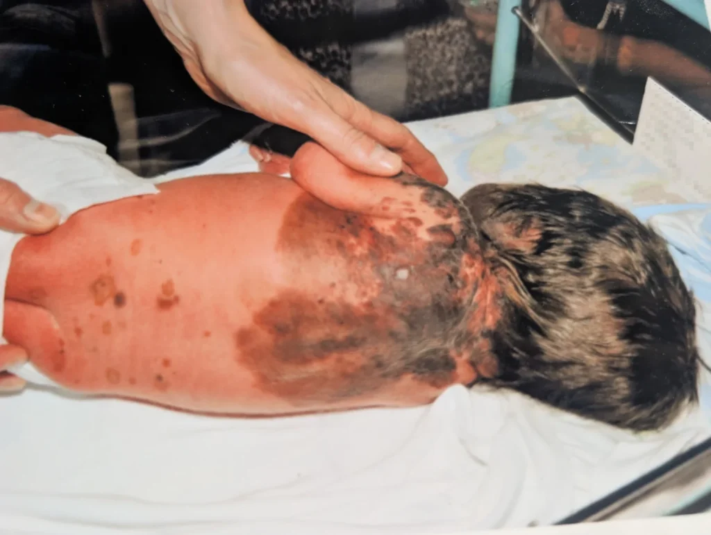 Mum feared for son's future after rare hairy birthmark covered half his face at birth, but he's now the most popular kid in school.