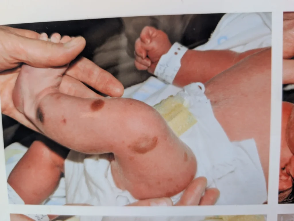 Mum feared for son's future after rare hairy birthmark covered half his face at birth, but he's now the most popular kid in school.