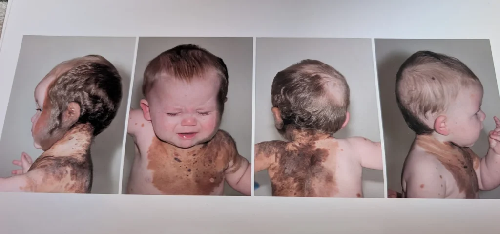 Mum feared for son's future after rare hairy birthmark covered half his face at birth, but he's now the most popular kid in school.
