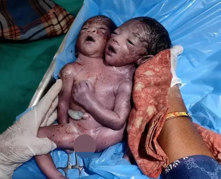 Extremely rare two-headed baby born with one body fights for life in India. Doctors say survival chances are poor due to complex abnormalities and health complications.