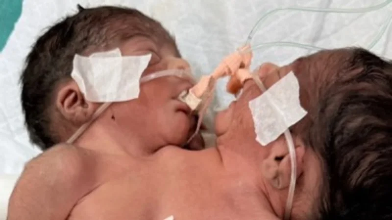 Extremely rare two-headed baby born with one body fights for life in India. Doctors say survival chances are poor due to complex abnormalities and health complications.