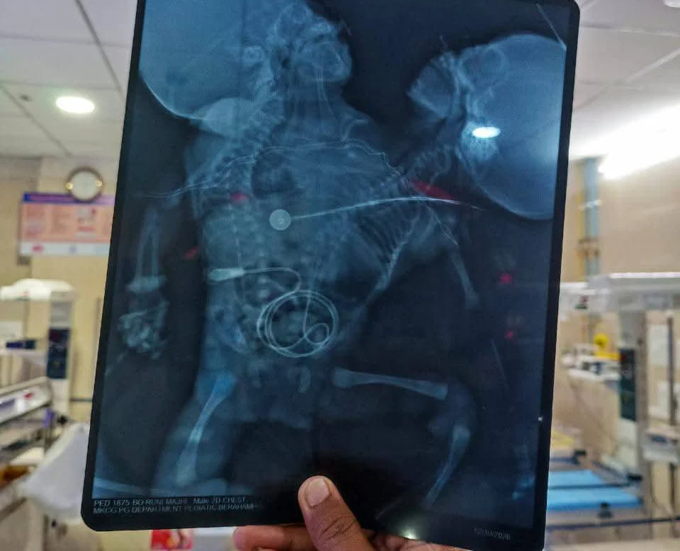 Extremely rare two-headed baby born with one body fights for life in India. Doctors say survival chances are poor due to complex abnormalities and health complications.