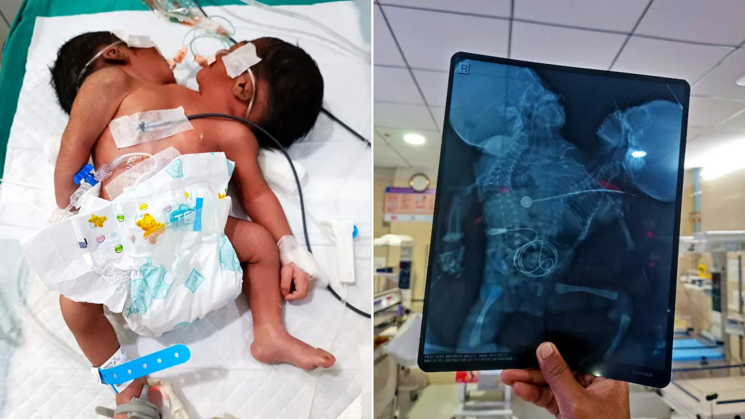 Extremely rare two-headed baby born with one body fights for life in India. Doctors say survival chances are poor due to complex abnormalities and health complications.