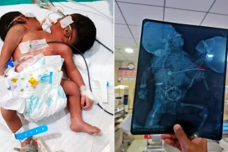 Extremely rare two-headed baby born with one body fights for life in India. Doctors say survival chances are poor due to complex abnormalities and health complications.