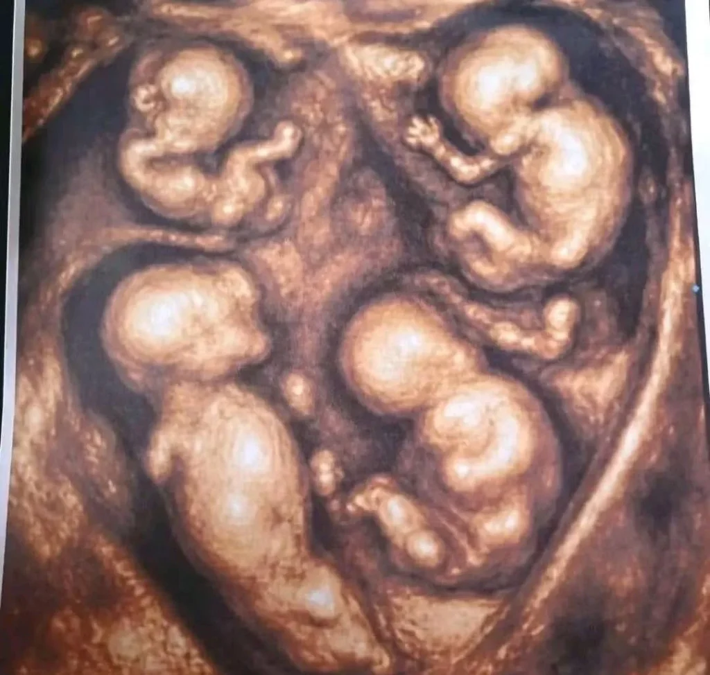 A mum has given birth to four identical baby boys in an extraordinary pregnancy believed to occur just once in every 15 million pregnancies.